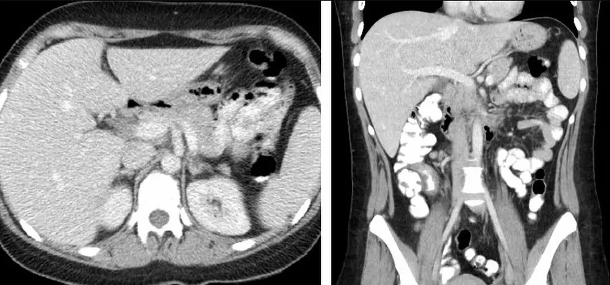 Abdomen and Pelvic CT Second Opinion
