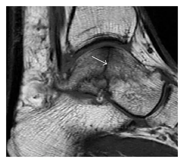 Ankle MRI Second Opinion