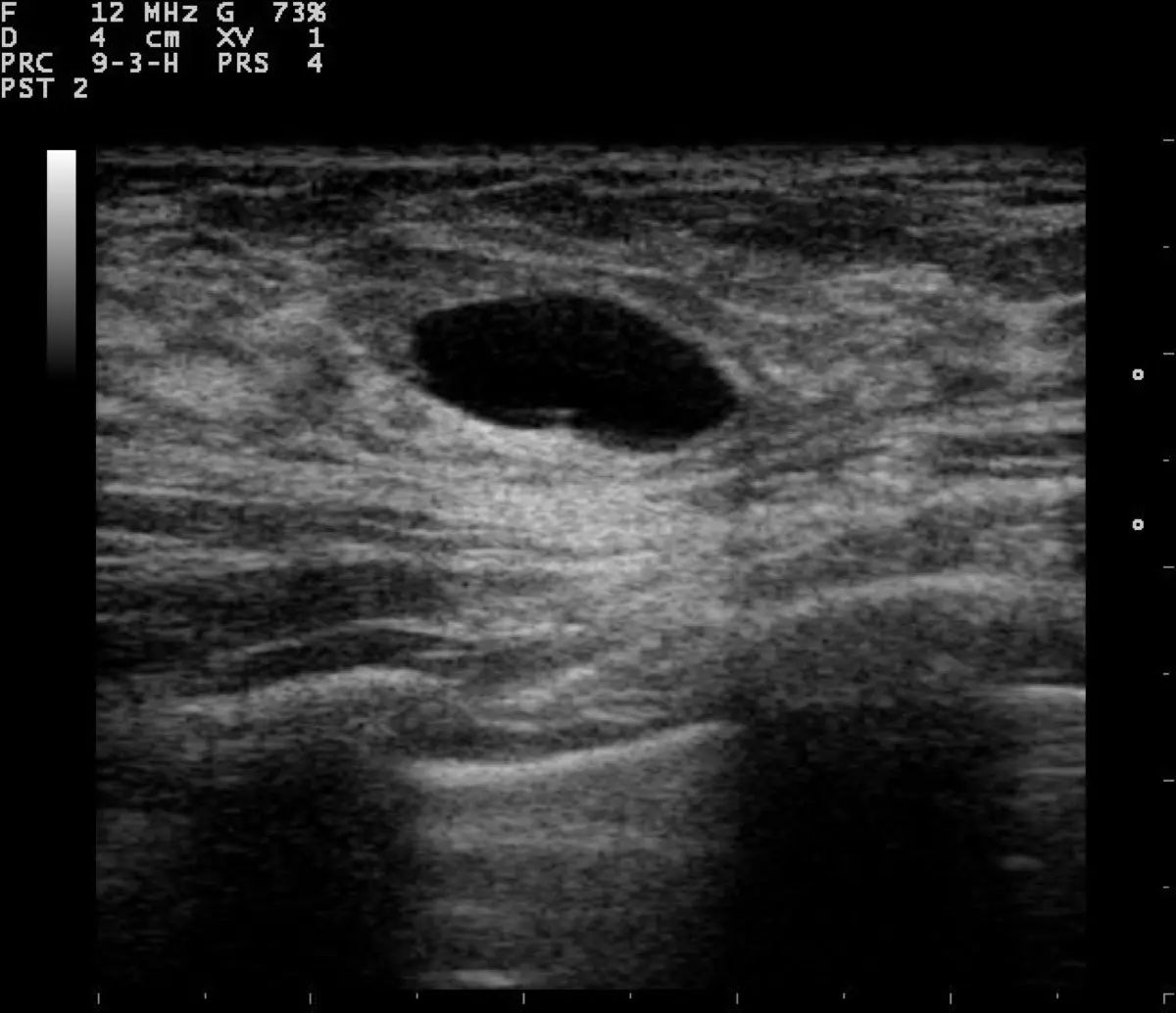 Breast Cyst on Ultrasound: What It Means, Causes, and When to Worry