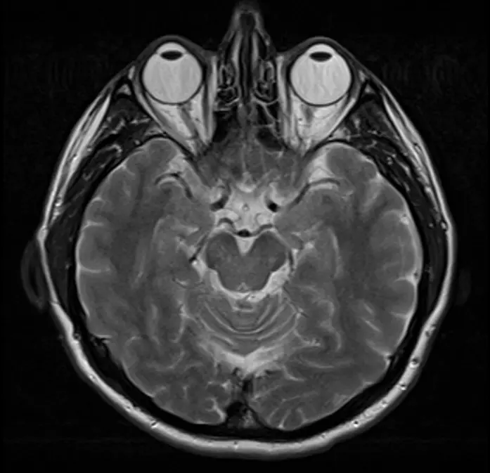 Can a Brain MRI Detect the Cause of Headaches?
