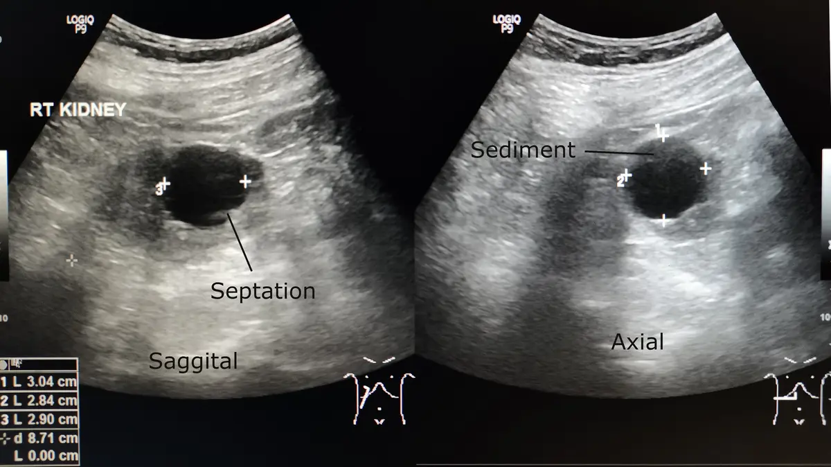 Can a Cyst Be Cancerous?