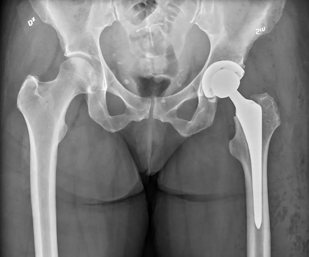 Can You Have an MRI With Metal in Your Body?