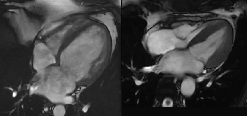 Cardiac MRI Second Opinion
