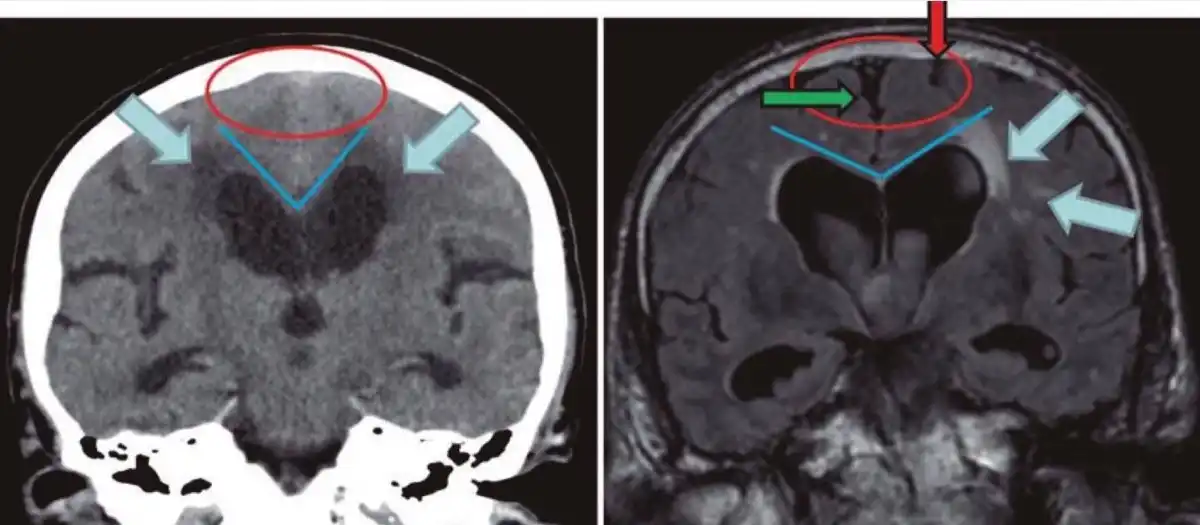 Brain MRI comparison showing cerebral atrophy with widened sulci and enlarged ventricles