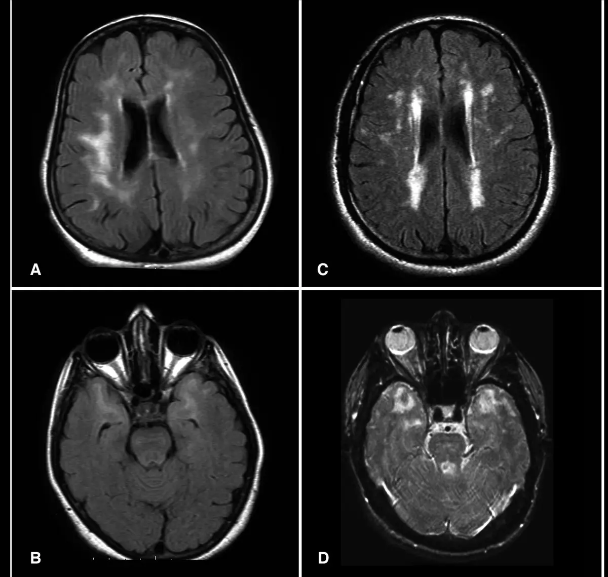 Brain MRI showing small white-matter lesions typical of chronic ischemic changes
