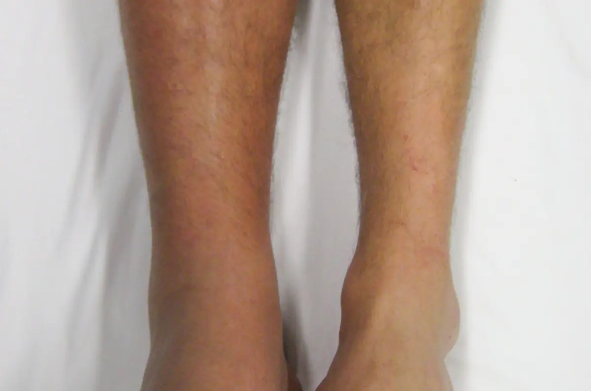 Deep Vein Thrombosis (DVT): What a Blood Clot in the Leg Means and When It's Serious