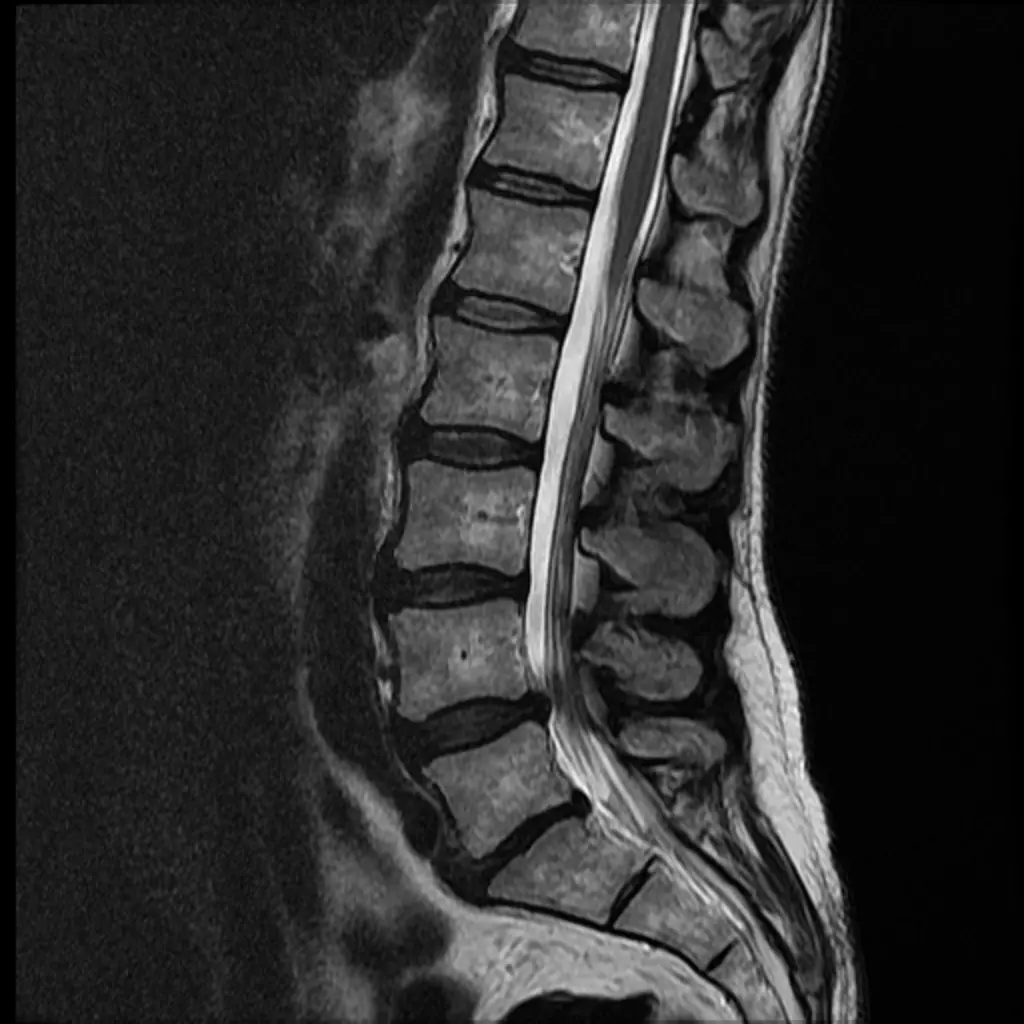 Degenerative Disc Disease on MRI: What It Means and When to Worry