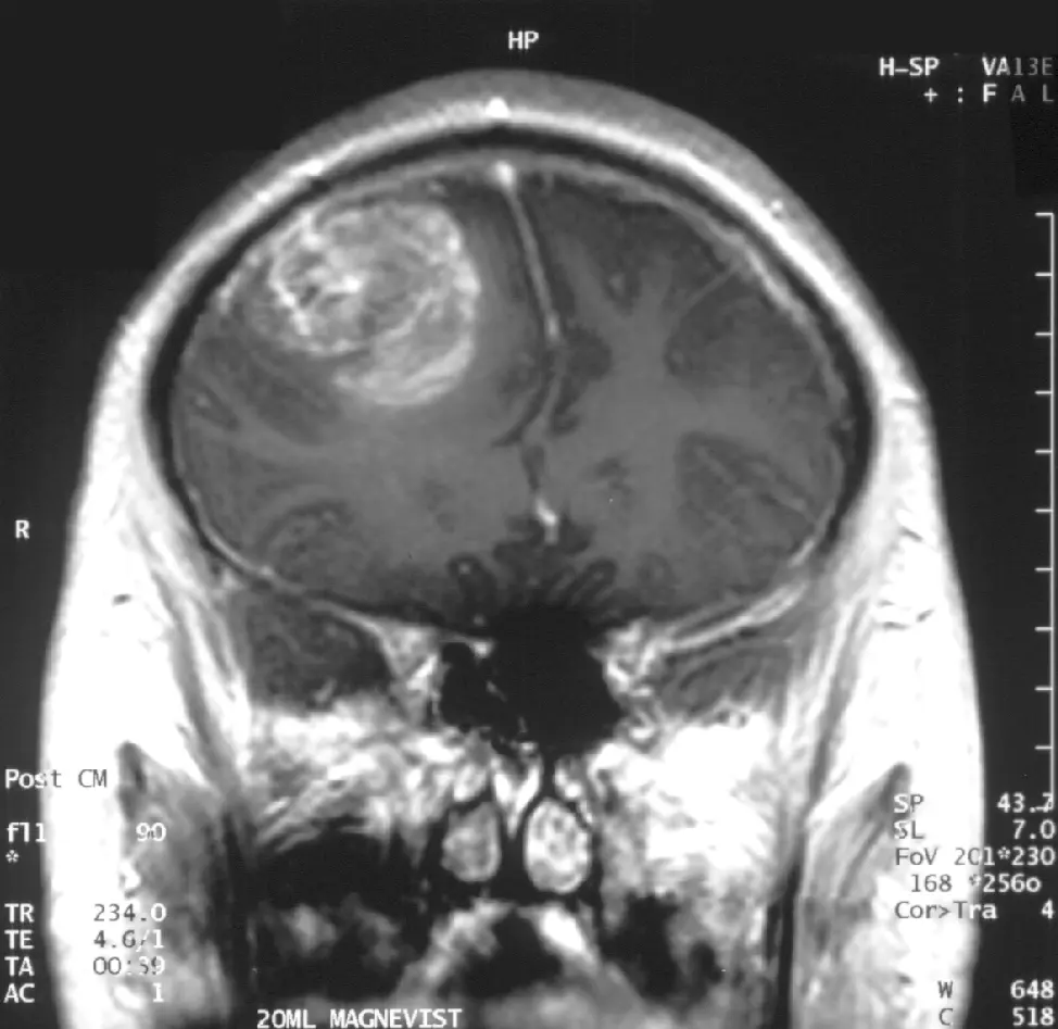 Do I Need Contrast for an MRI?