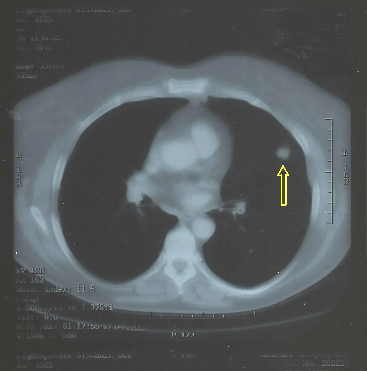 Does a Lung Nodule Mean Cancer?