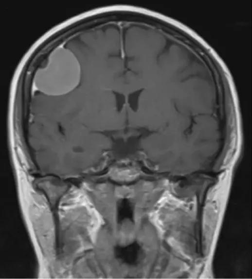 What Does "Dural Tail" Mean in a Radiology Report?