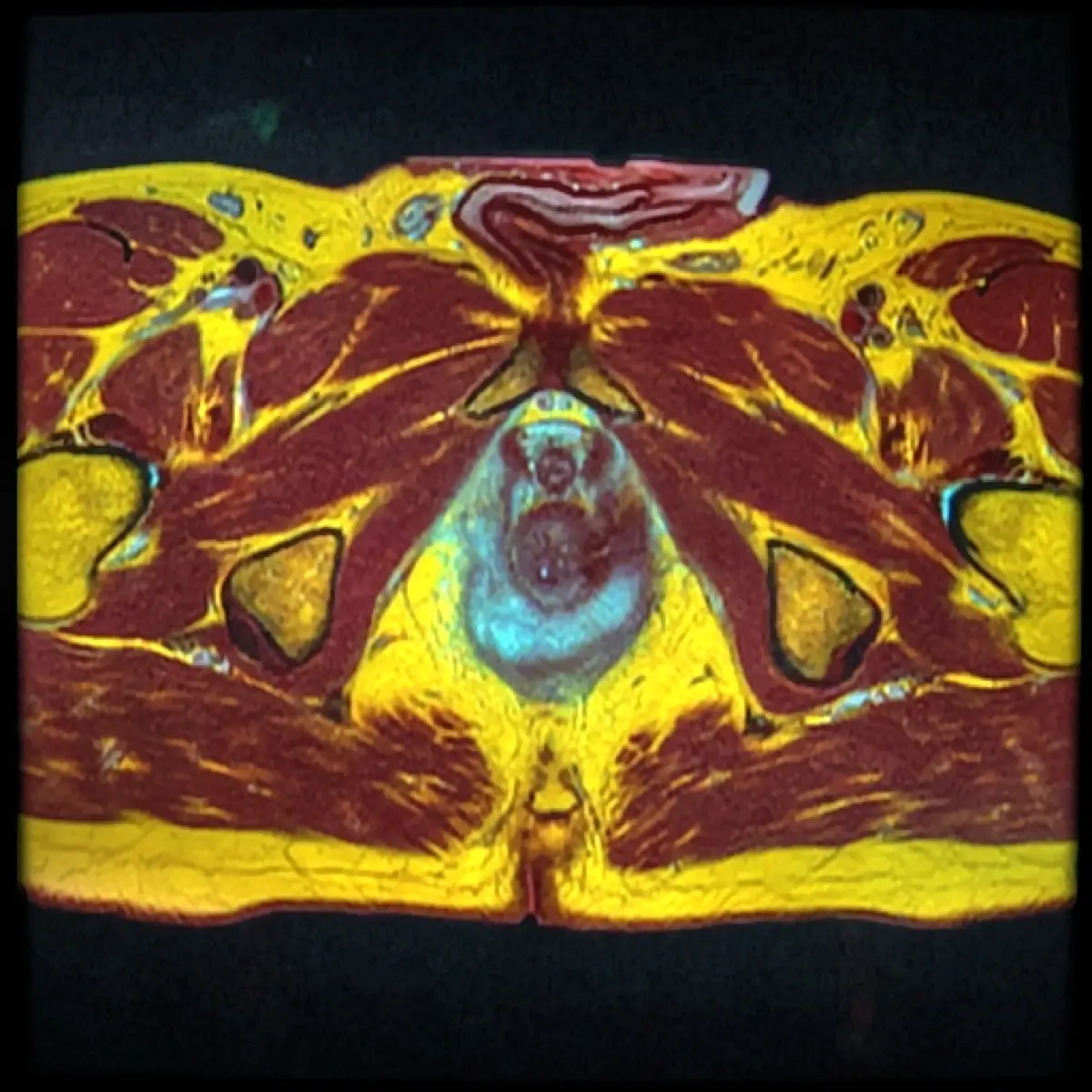 Enlarged Prostate (BPH): What It Means, Symptoms, and When to Worry