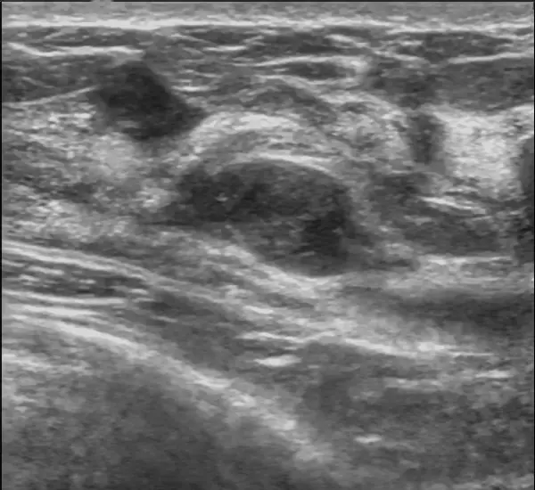 Breast ultrasound showing a well-circumscribed oval hypoechoic mass typical of a fibroadenoma