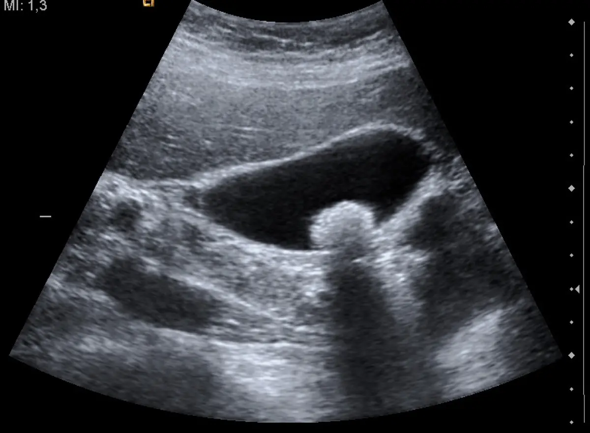 Gallstones on Ultrasound: What They Mean, Causes, and When Treatment Is Needed