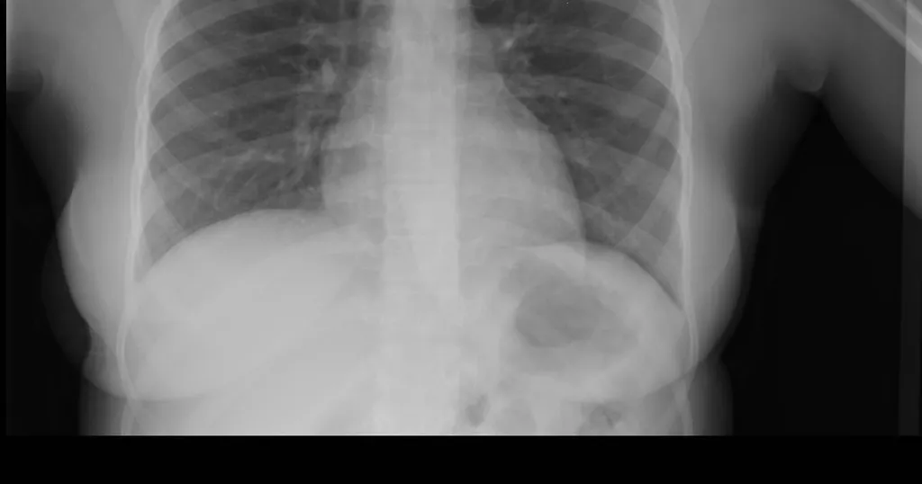 What Does "Ground-Glass Opacity" Mean in a Radiology Report?
