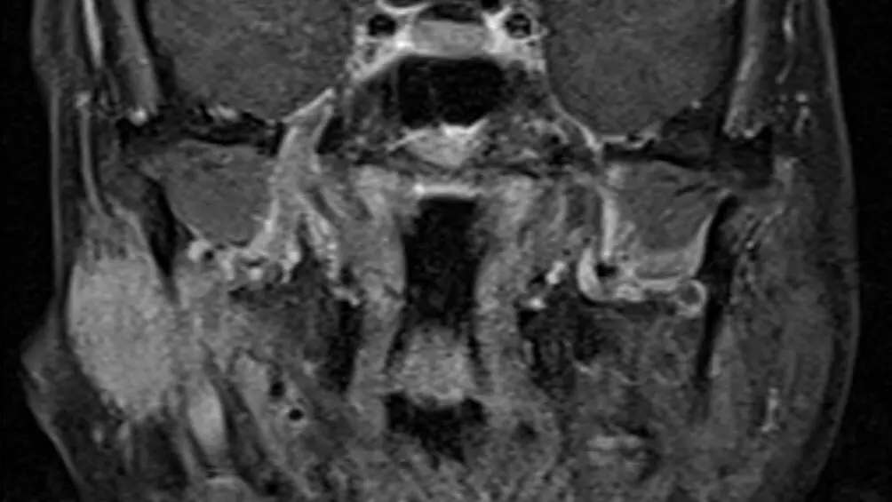 Head and Neck MRI Second Opinion