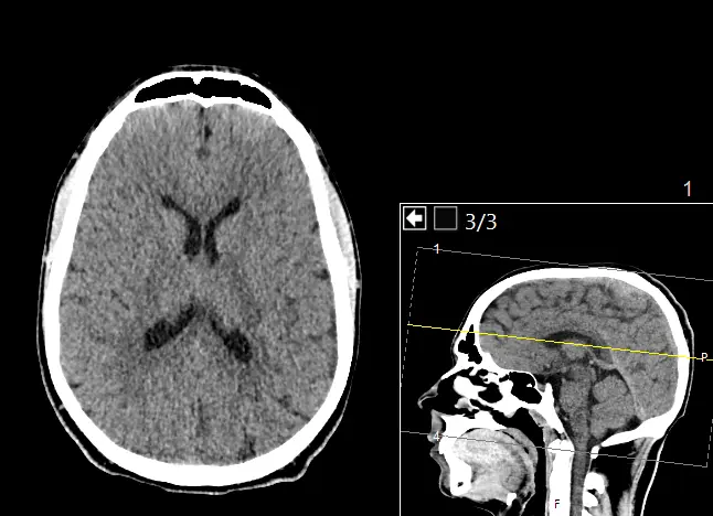Head CT Second Opinion
