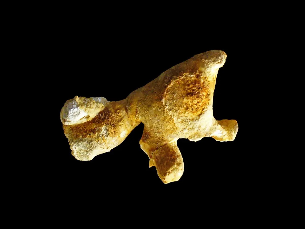 Kidney Stones on CT and Ultrasound: Causes, Symptoms, and Treatment