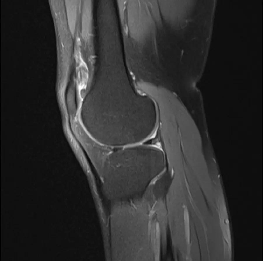 Knee MRI Second Opinion