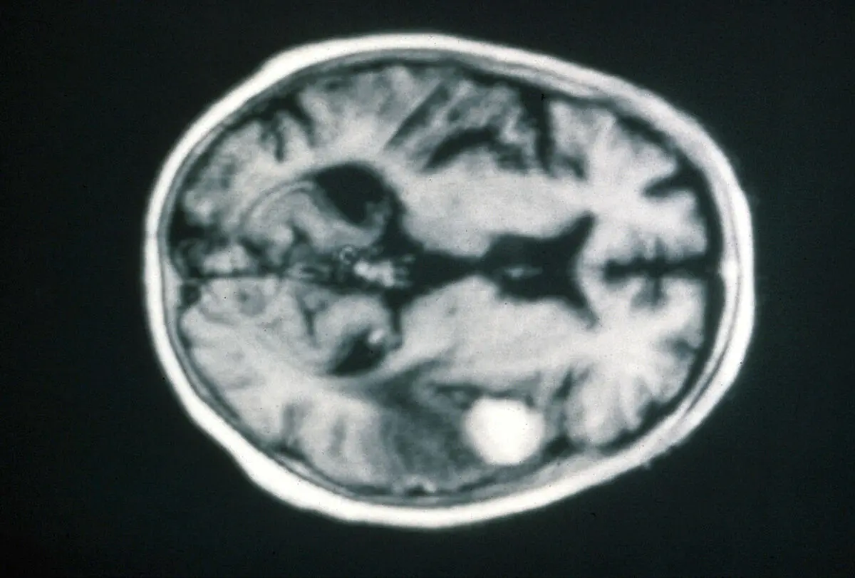 Meningioma on MRI: What It Means, Causes, and When to Worry