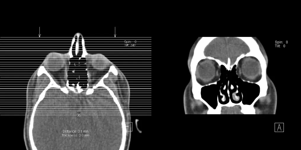 CT scan of the paranasal sinuses showing mucosal thickening of the maxillary sinuses