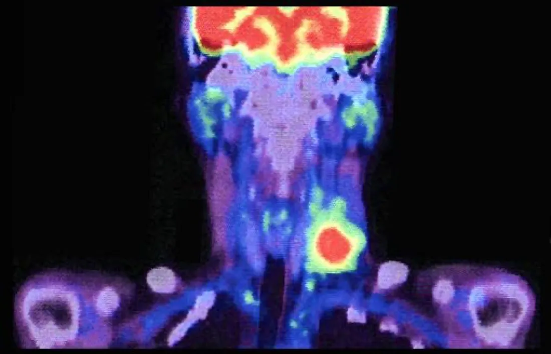 Hypermetabolic and SUV on a PET-CT Scan: What They Mean