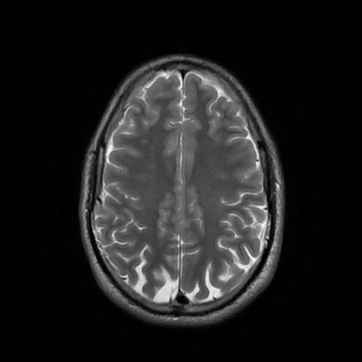 Prominent CSF Spaces on Brain MRI: What It Means and When It Matters