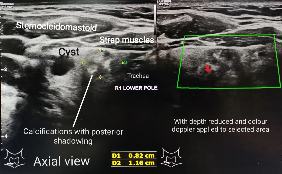 Thyroid Nodule on Ultrasound: What It Means, Causes, and When to Worry