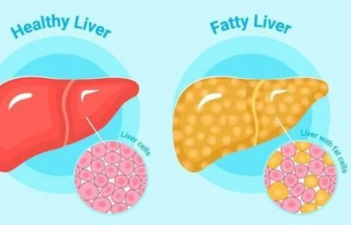 Understanding Fatty Liver Disease: The Role of MRI in Diagnosis and Management