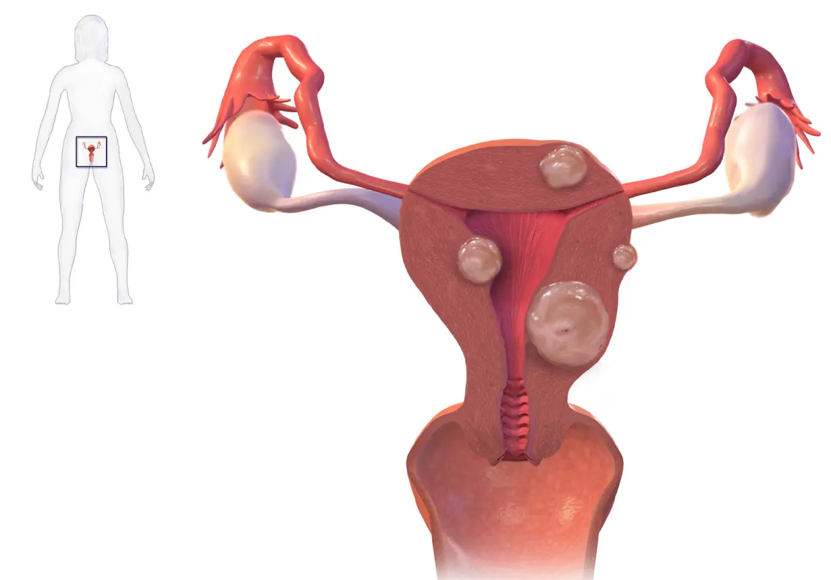 Uterine Fibroids: What They Are, How They're Found, and When to Worry