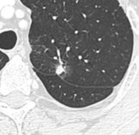 Axial CT slice showing an 8 mm spiculated nodule in the left upper lobe with pleural retraction