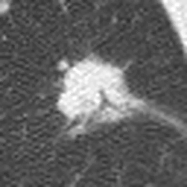 Magnified view of the same nodule, outlined, with the 18 mm long axis and the 15 mm short axis marked.
